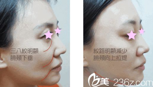 面部代表线雕提升效果