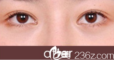 北海哪家医院做双眼皮手术好？分享一下我在北海李鑫做韩式三点双眼皮的效果