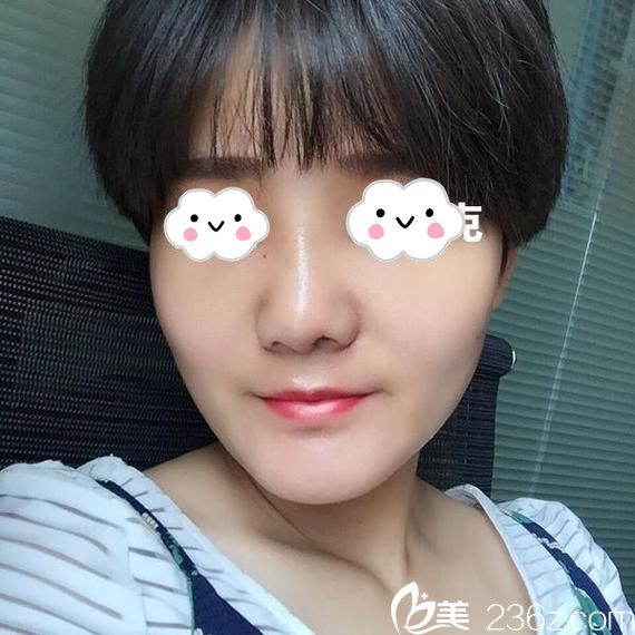 淮北微悦硅胶假体隆鼻真人案例