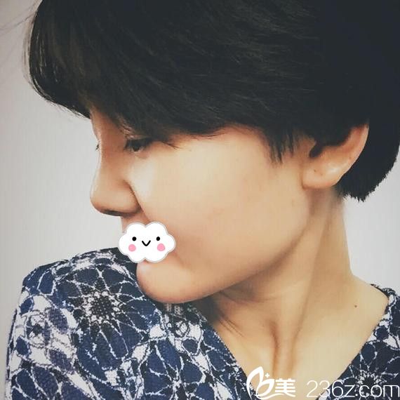 淮北微悦假体隆鼻术后恢复效果