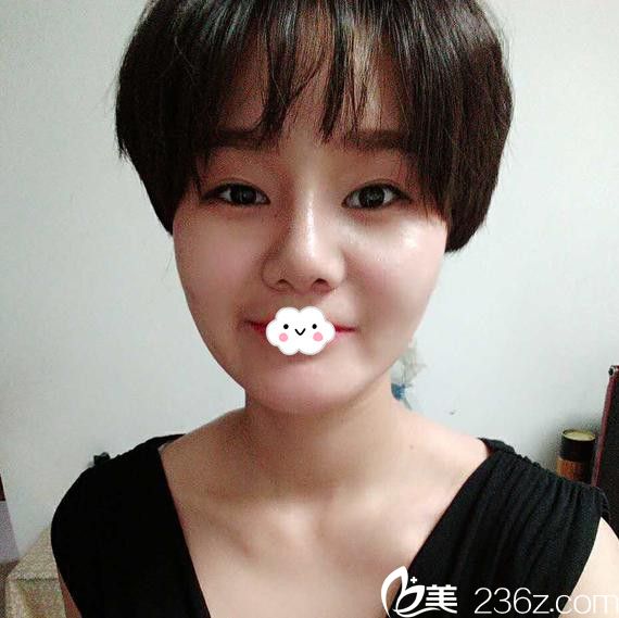 淮北微悦真人隆鼻效果好吗？