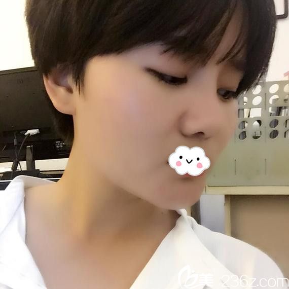 看我鼻整形真人案例就知道淮北微悦硅胶假体隆鼻效果怎么样了