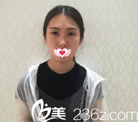 术前单眼皮 术前单眼皮