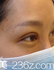 刚做完双眼皮眼睛肿胀 刚做完双眼皮眼睛肿胀