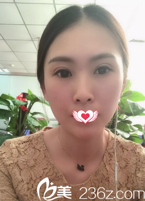 双眼皮恢复16天完全消肿 双眼皮恢复16天完全消肿