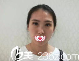 恢复7天后双眼皮拆线后的样子 恢复7天后双眼皮拆线后的样子