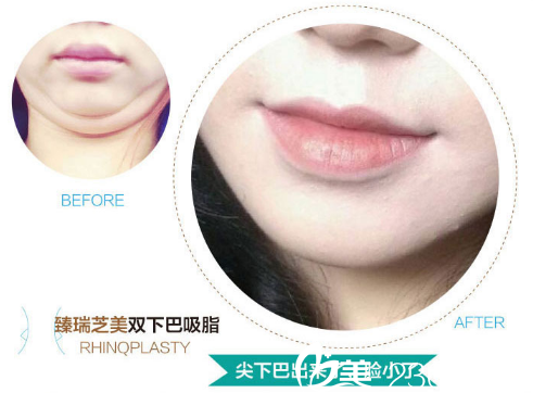 深圳臻瑞芝美医疗美容医院双下巴吸脂案例图片