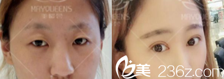 太原美媛荟整形双眼皮效果图