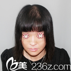 杨杰医生给我做完头发种植三个月 杨杰医生给我做完头发种植三个月