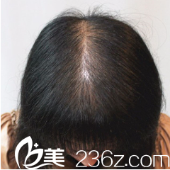 重庆时光整形头发种植术后四个月 重庆时光整形头发种植术后四个月