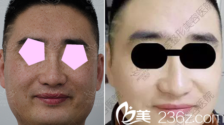 太原美媛荟面部激光祛斑前后效果对比图