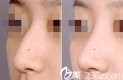 太原美媛荟鼻综合隆鼻前后效果对比图