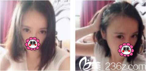上海凯渥医疗美容门诊陈小萱双眼皮真人案例术后一个月