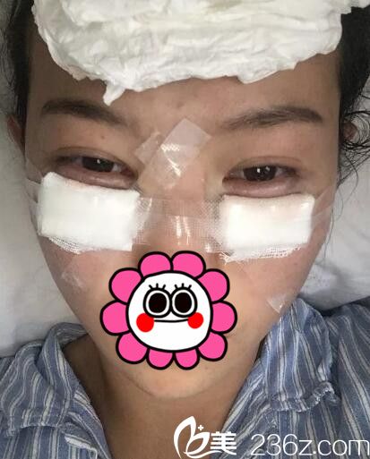 刚做完去眼袋手术