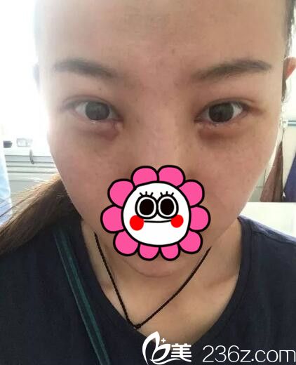 拆掉纱布看眼袋恢复情况