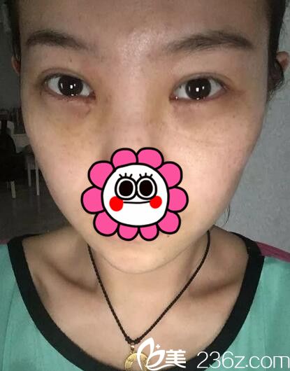 内切法去眼袋术后恢复