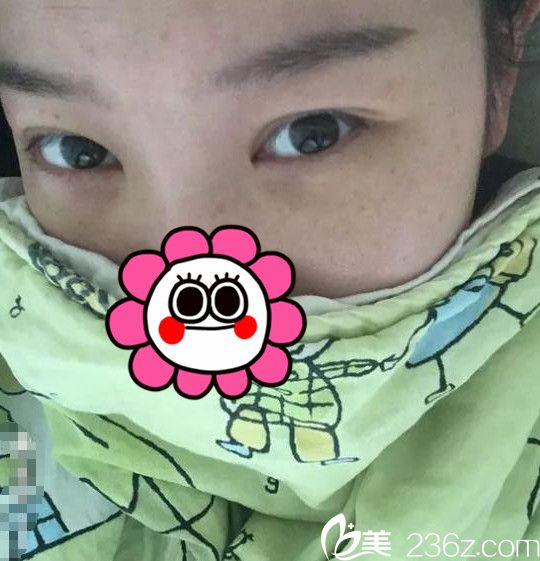 去眼袋术后一周恢复