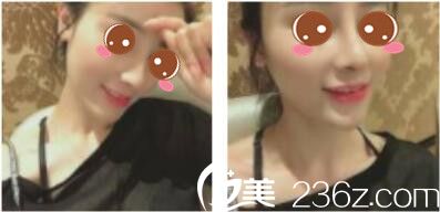关于上海凯渥陈小萱做鼻子的一些个人看法，做完假体隆鼻后消肿大概用了一个多月的时间