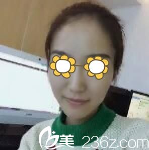 脸部自体脂肪填充前 脸部自体脂肪填充前