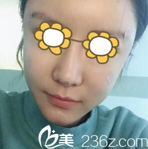 面部自体脂肪填充术后3天 面部自体脂肪填充术后3天