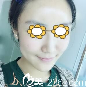 自体脂肪填充面部术后8天 自体脂肪填充面部术后8天