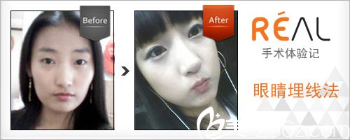 韩国丽儿整形医院案例对比效果 韩国丽儿整形医院案例对比效果