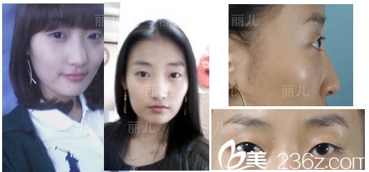 韩国丽儿整形隆鼻后3天 韩国丽儿整形隆鼻后3天