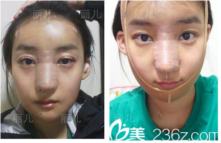 韩国丽儿整形医院双眼皮手术真人案例