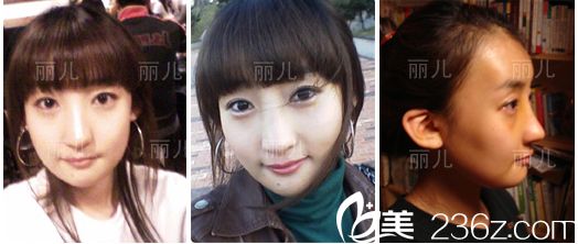 韩国丽儿整形医院颧骨缩小案例 韩国丽儿整形医院颧骨缩小案例