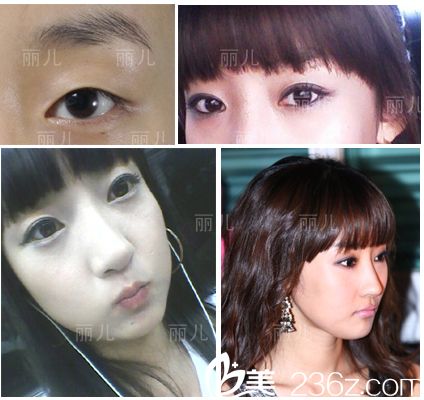 美女变形记：分享下我在韩国丽儿整形医院找做双眼皮+隆鼻+颧骨内推后的变化过程