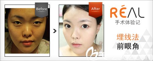 韩国丽儿整形医院埋线双眼皮手术真人案例 韩国丽儿整形医院埋线双眼皮手术真人案例