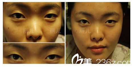 双眼皮手术前照片 双眼皮手术前照片