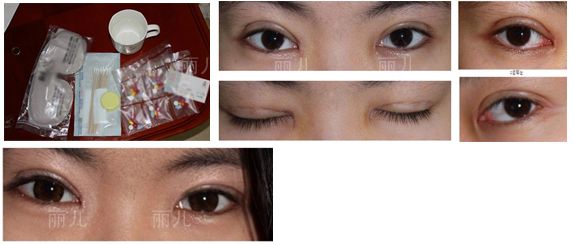 金寿信给我做双眼皮手术一周了 金寿信给我做双眼皮手术一周了