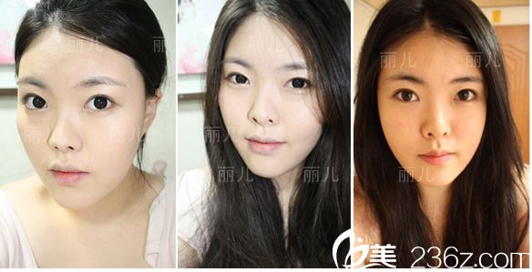 韩国丽儿整形医院做双眼皮怎么样？分享下金寿信做埋线双眼皮手术真人案例