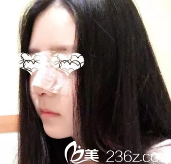 鼻综合手术2天鼻子肿胀