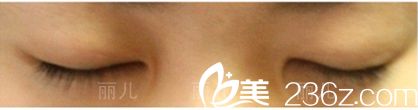 双眼皮手术回复后闭眼效果 双眼皮手术回复后闭眼效果
