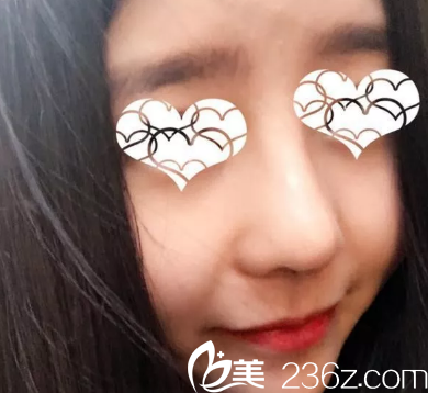 7天拆线后鼻子恢复情况