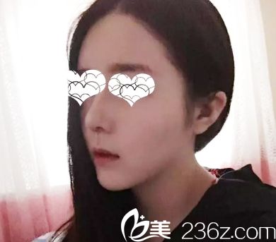 术后18天鼻子完全消肿
