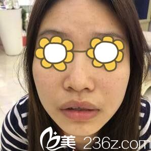 鼻综合术前照 鼻综合术前照