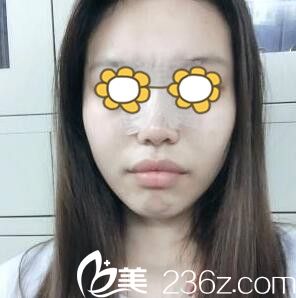 鼻综合术后3天 鼻综合术后3天