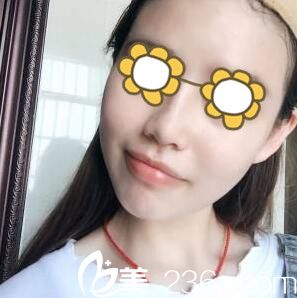 鼻综合术后一周拆线 鼻综合术后一周拆线