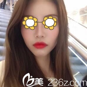 鼻综合术后半个月 鼻综合术后半个月