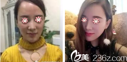 刘乃仁面部线雕案例 刘乃仁面部线雕案例