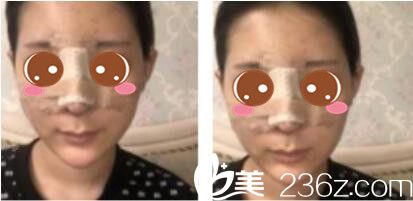 上海保加医疗美容门诊部杨勇鼻综合真人案例术后第三天