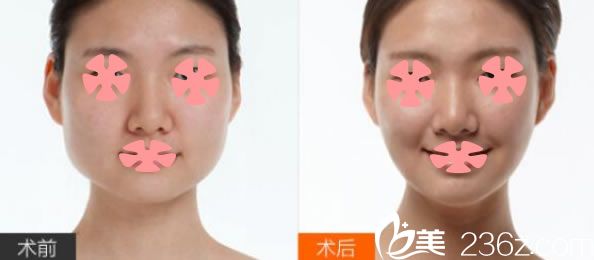赵弘宇医生精细改脸型案例及前后对比效果