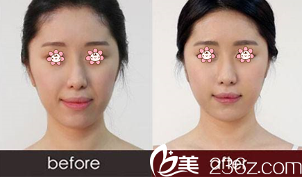 黄硕医师玻尿酸填充法令纹案例 黄硕医师玻尿酸填充法令纹案例