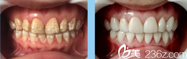 秦彪医师牙齿贴面修复案例 秦彪医师牙齿贴面修复案例