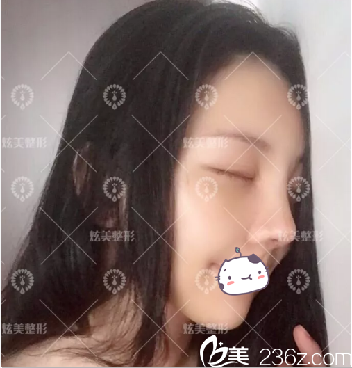 北京炫美假体垫下巴和鼻综合头一个3天样子