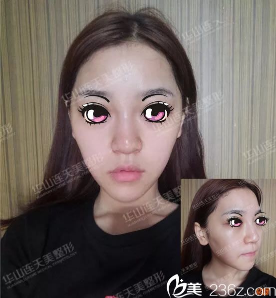 修复前注射奥美定隆鼻照片 修复前注射奥美定隆鼻照片