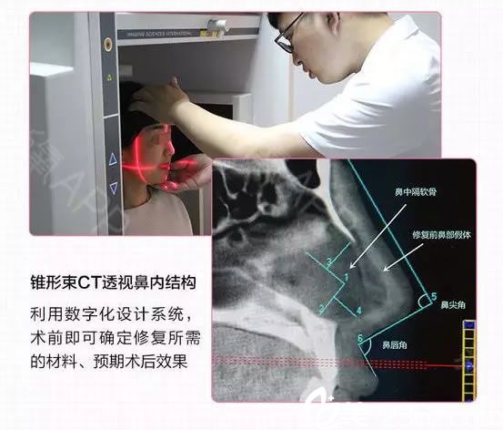 一年前以为便宜就能变美,在朋友推荐下在一个工作室做了注射隆鼻手术